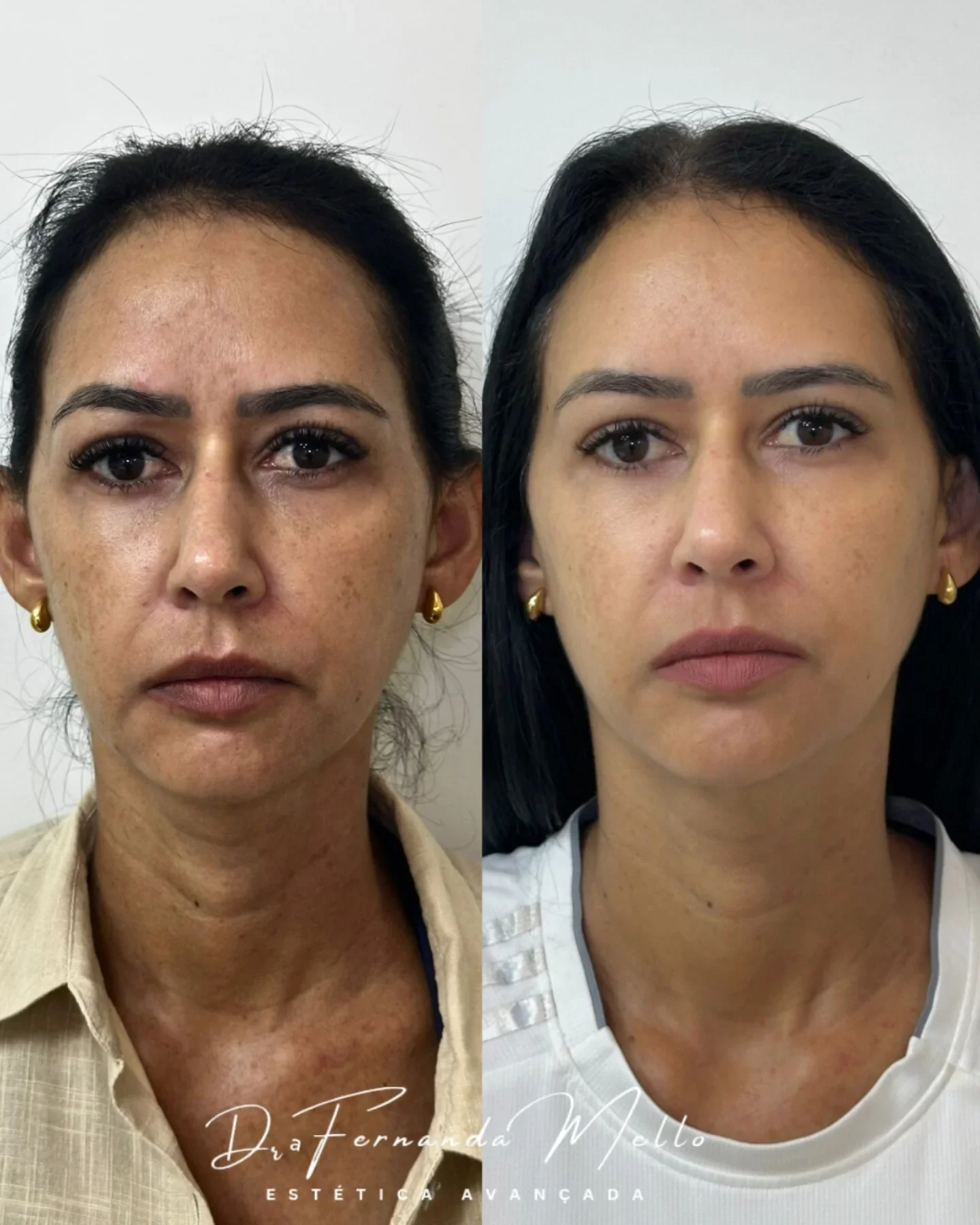 Antes e Depois 10