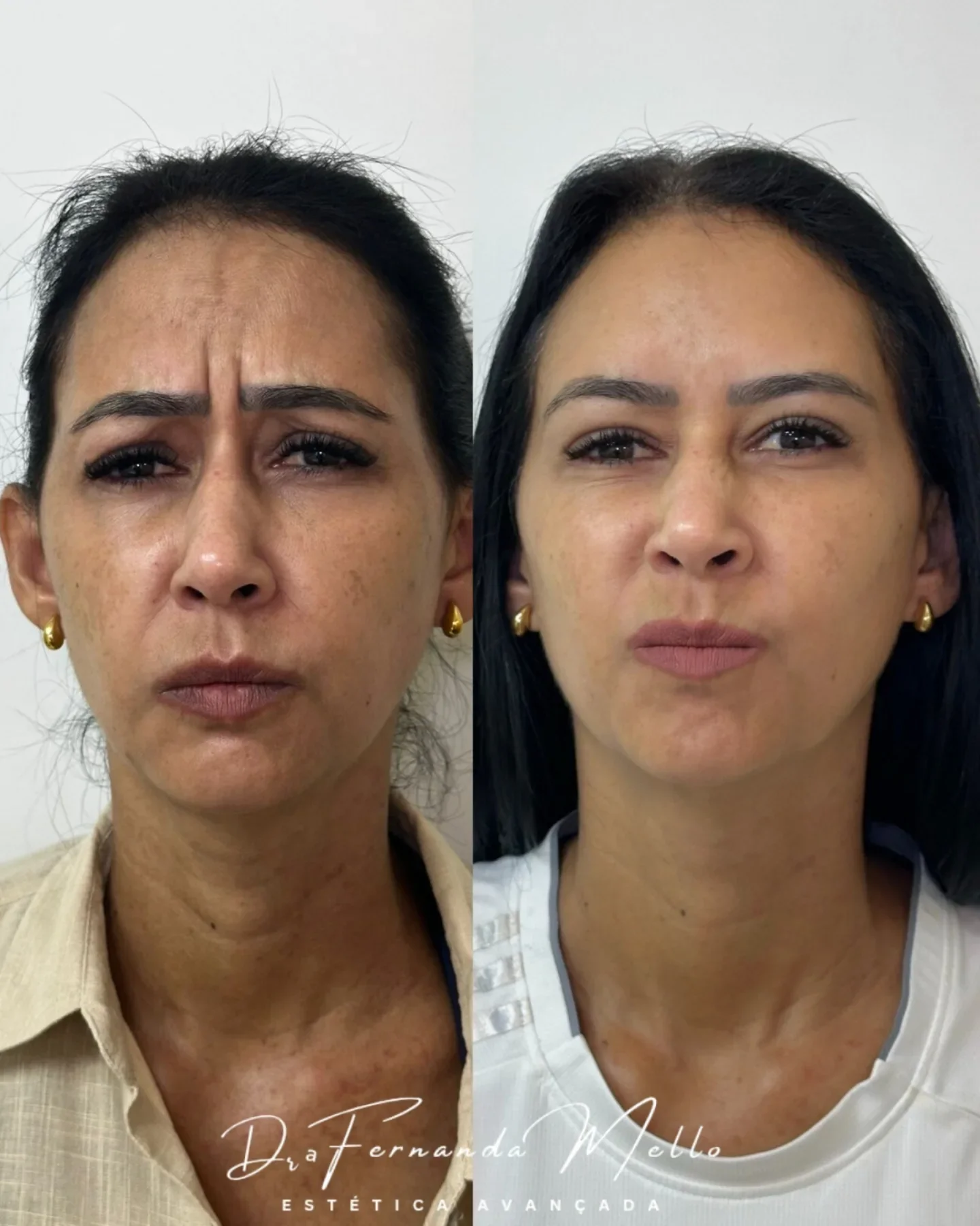 Antes e Depois 11