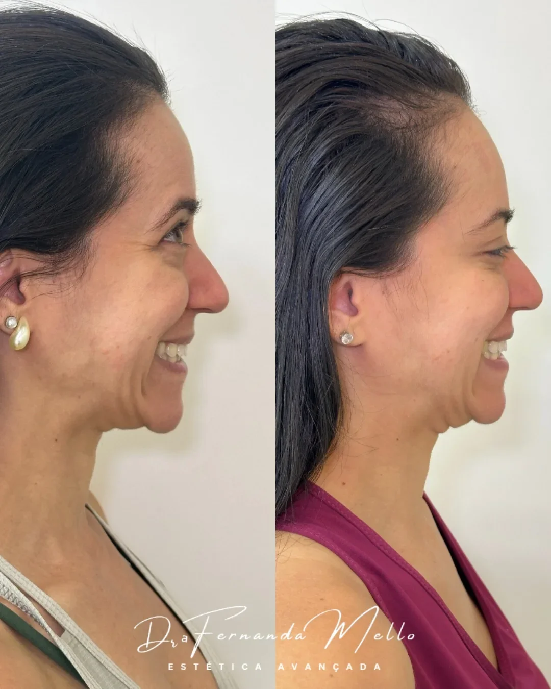 Antes e Depois 17