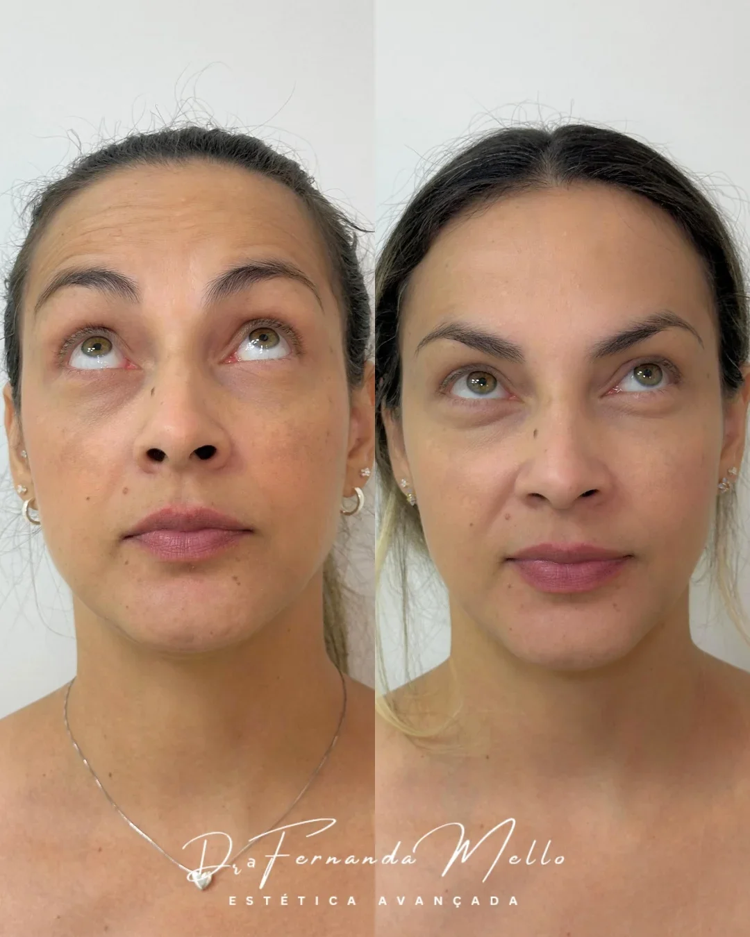 Antes e Depois 22