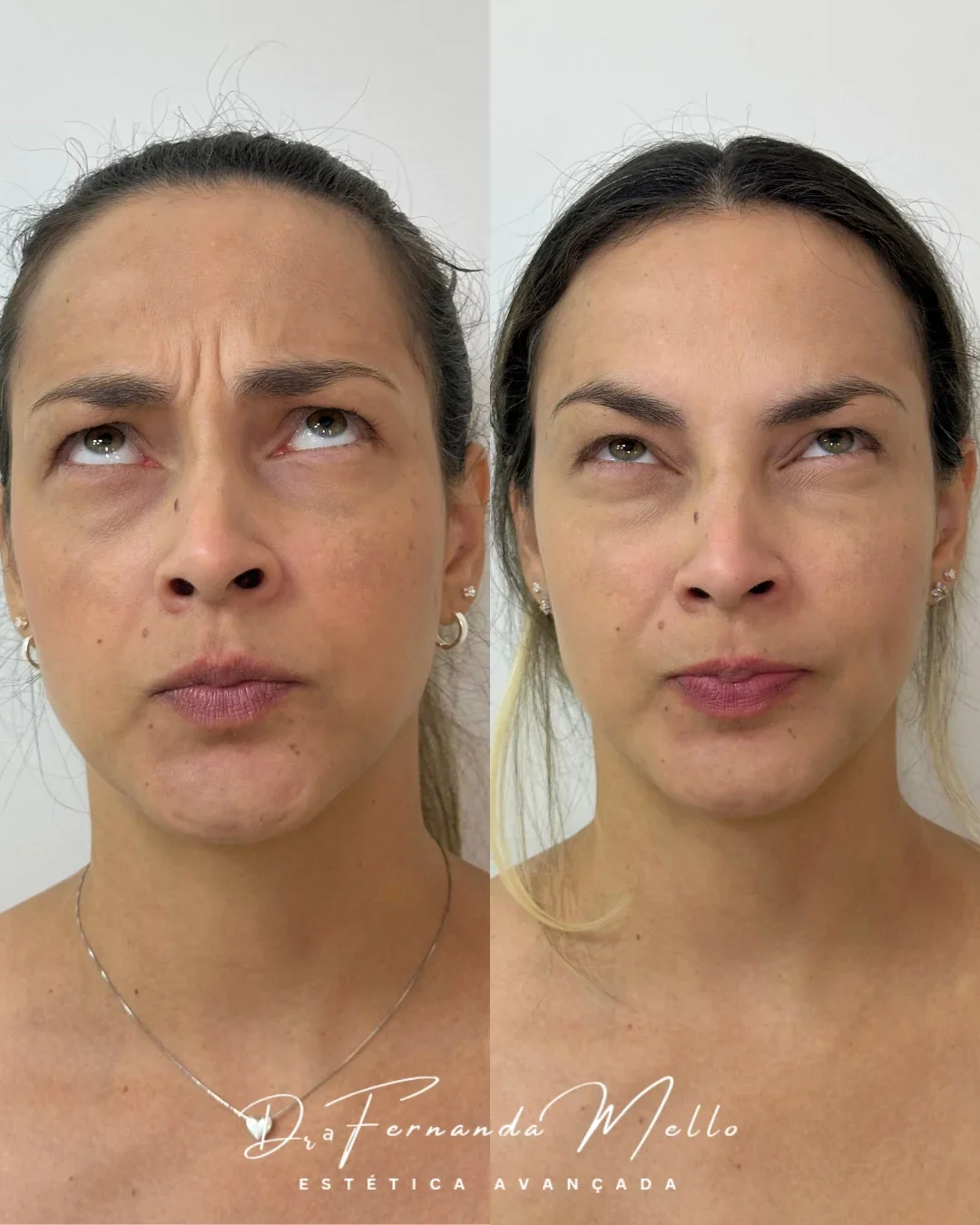 Antes e Depois 23