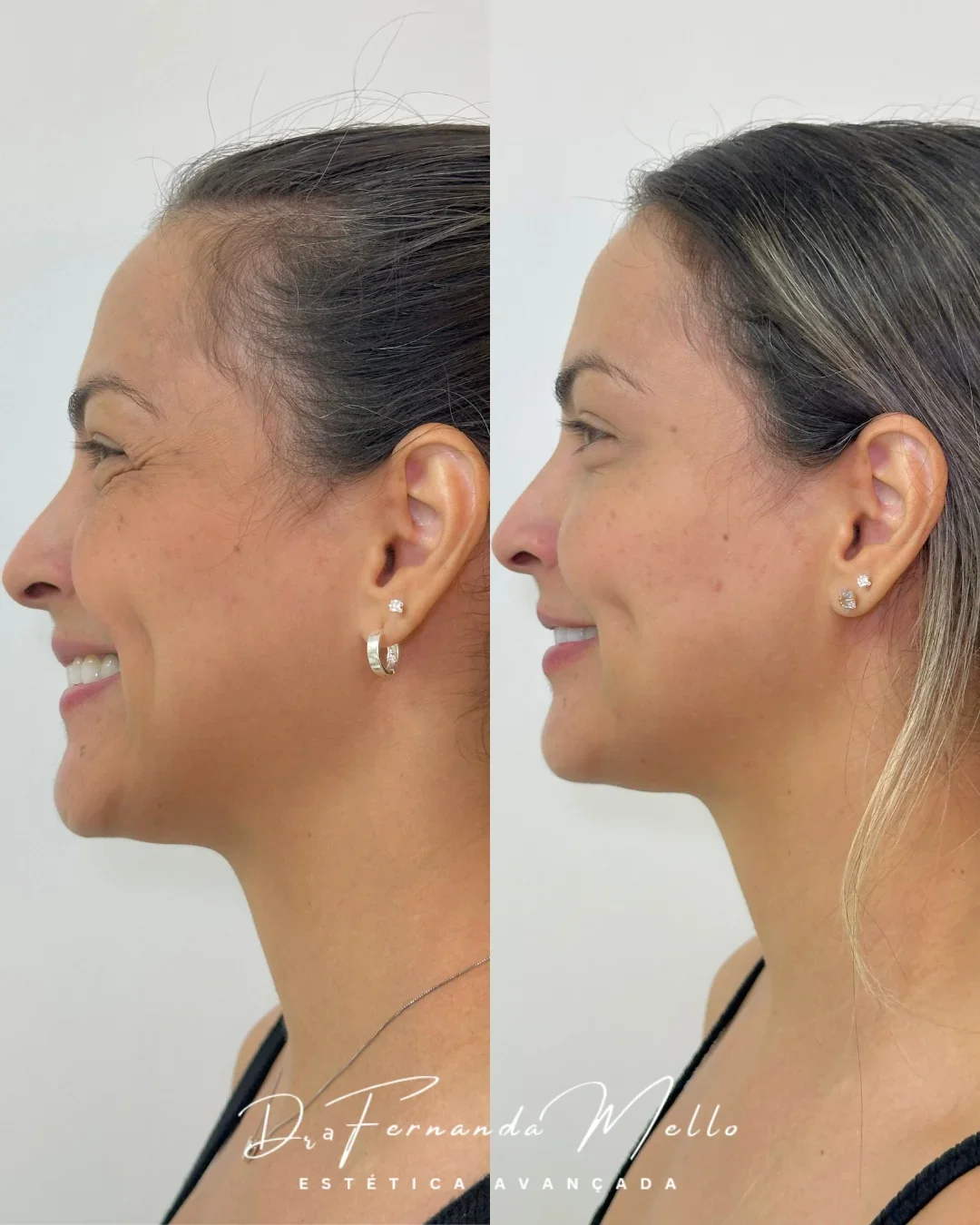 Antes e Depois 24
