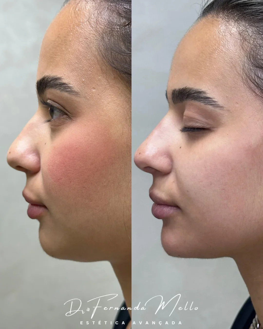 Antes e Depois 4