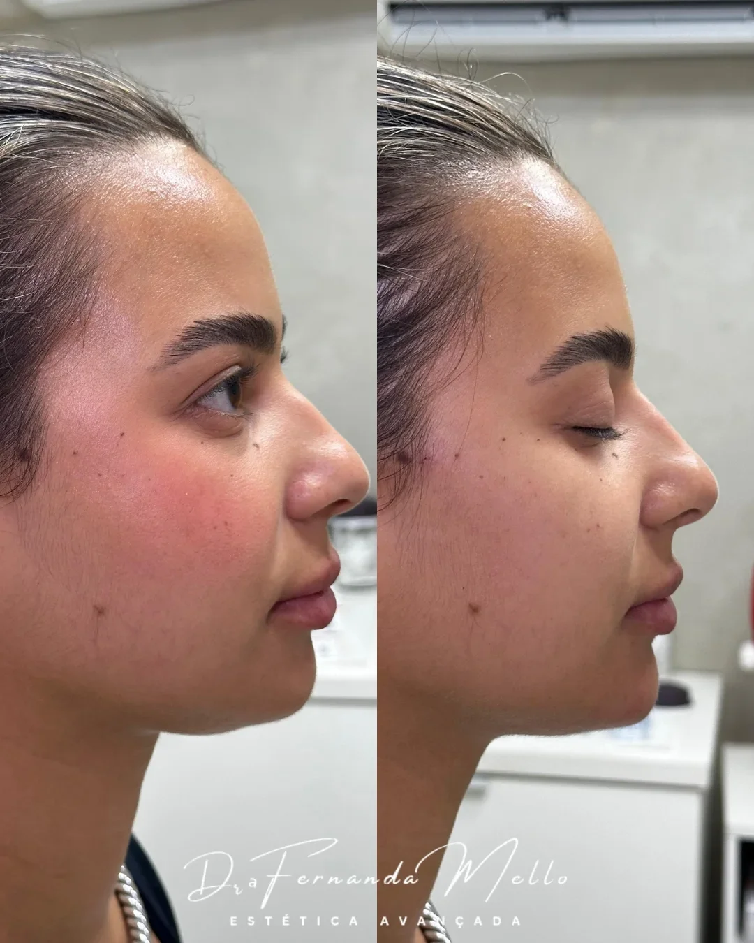 Antes e Depois 5