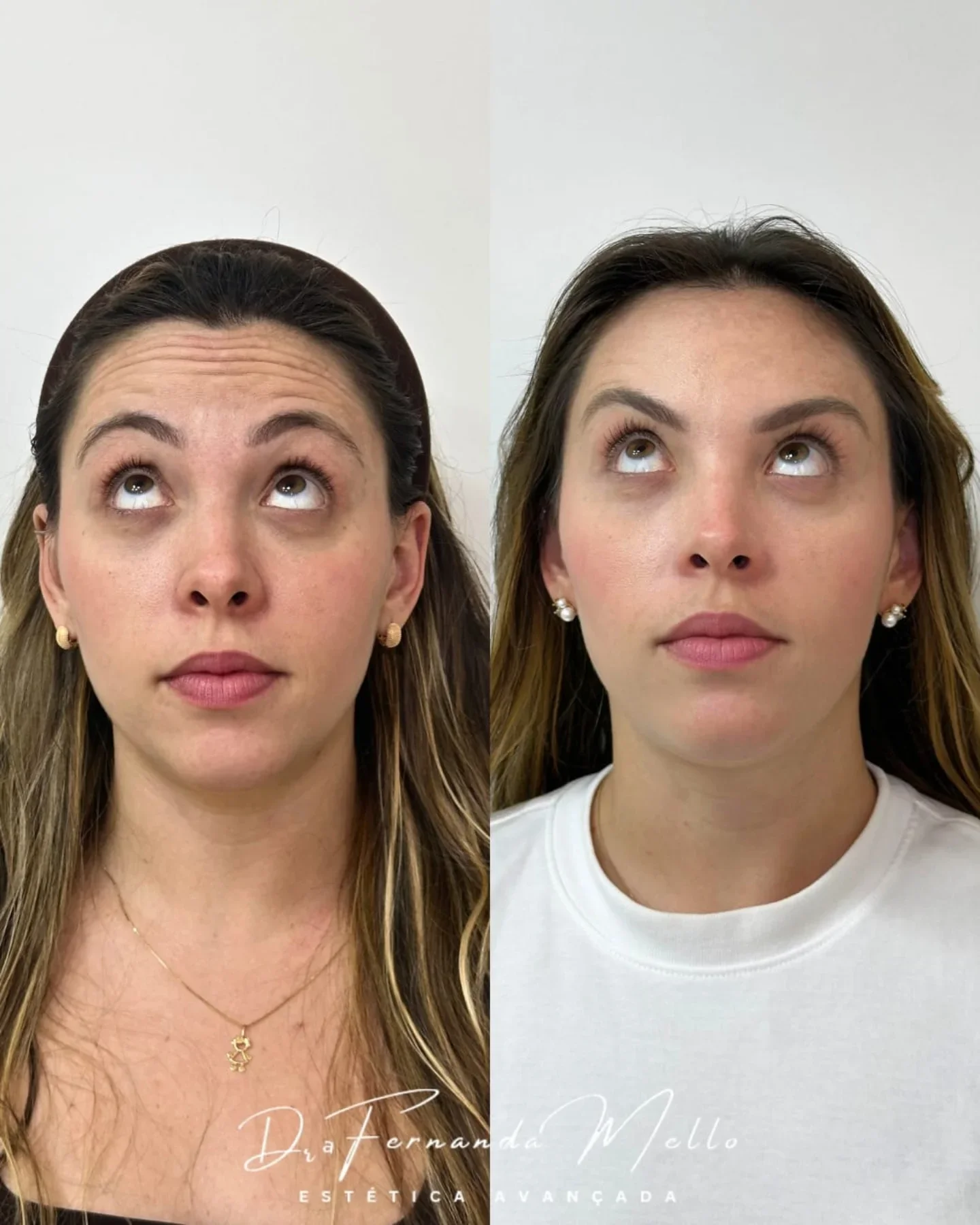 Antes e Depois 7
