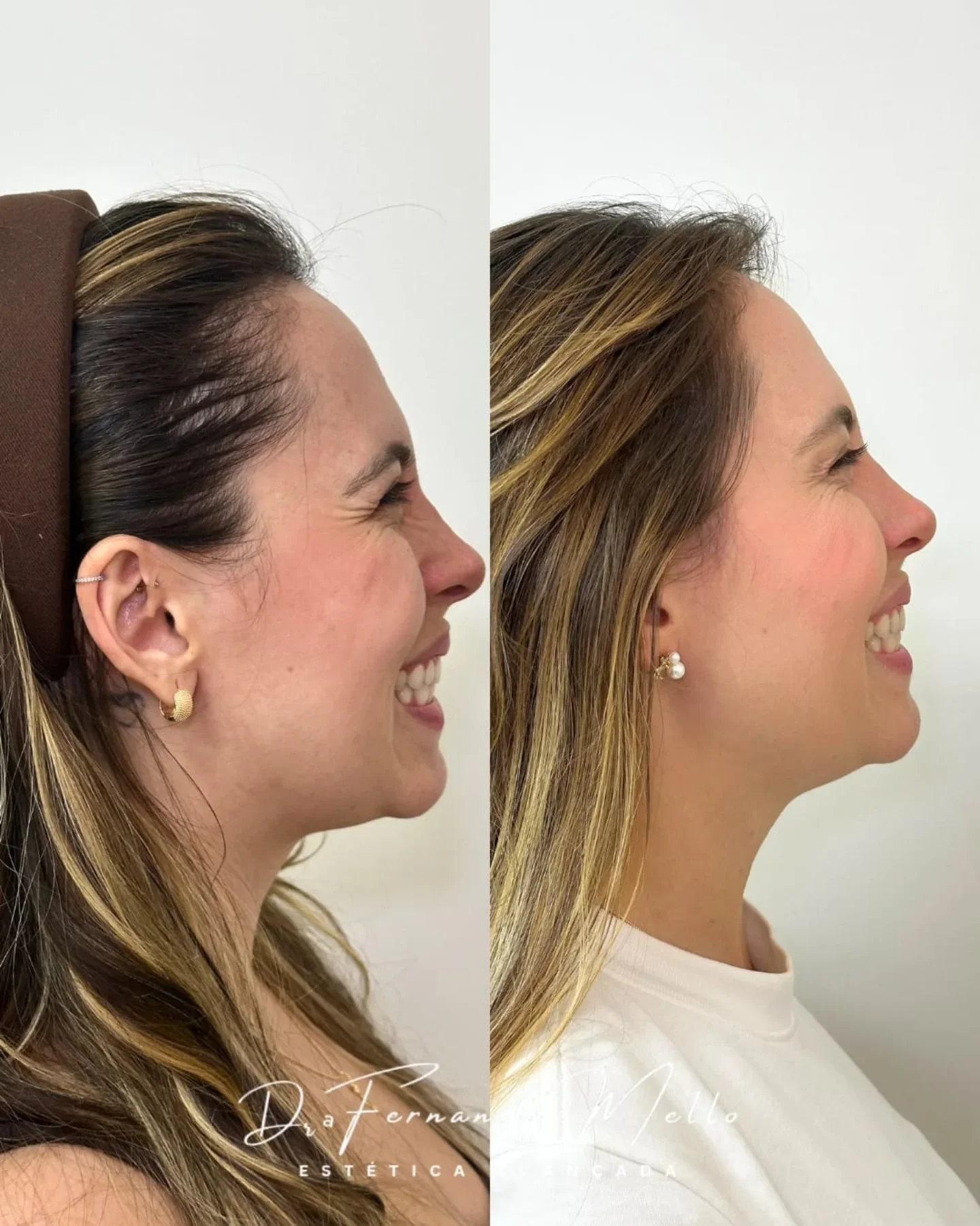 Antes e Depois 9